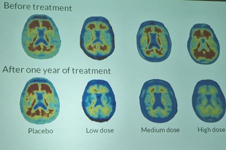 Mozgani pred in po zdravljenju